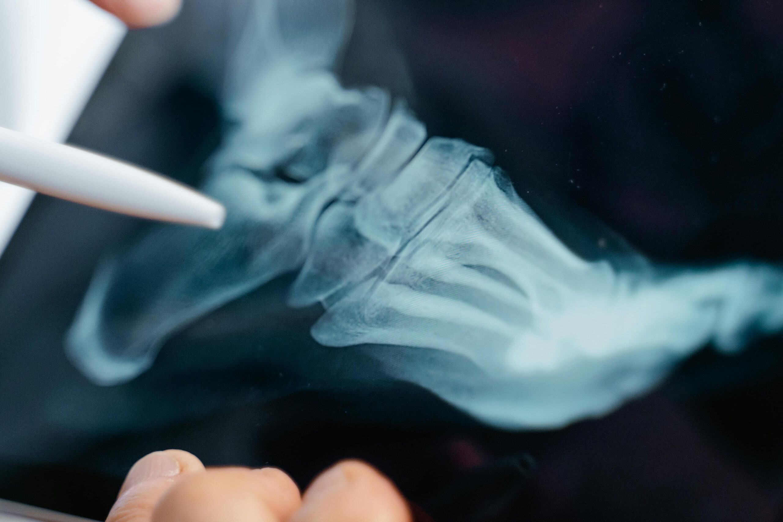 Why Preventive Bone Health Deserves a Bigger Slice of Public Health Funding