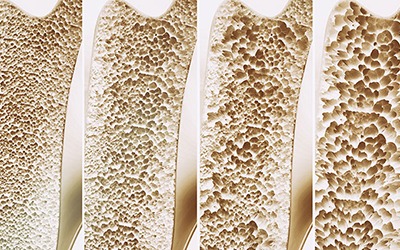 Osteoporosis-What-You-Should-Know-at-All-Ages Osteoporosis-What-You-Should-Know-at-All-Ages