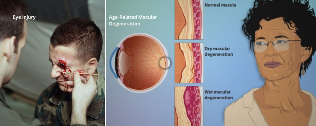 What Causes Low Vision?