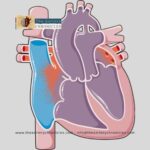 Transposition of great arteries