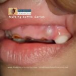Nursing bottle caries. Source: wikimedia commons