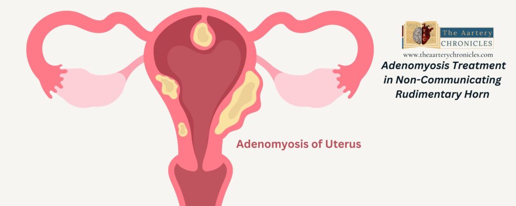 Adenomyosis-of -uterus-The-Aartery-chronicles-TAC