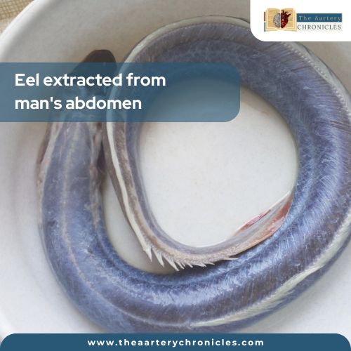 eel-extraction-from-abdomen-the-aaartery-chronicles-tac