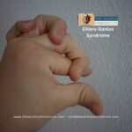Ehlers-Danlos Syndrome