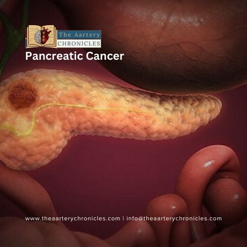 pancreatic cancer