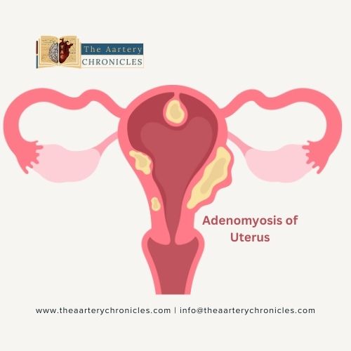 Adenomyosis-of -uterus-The-Aartery-chronicles-TAC