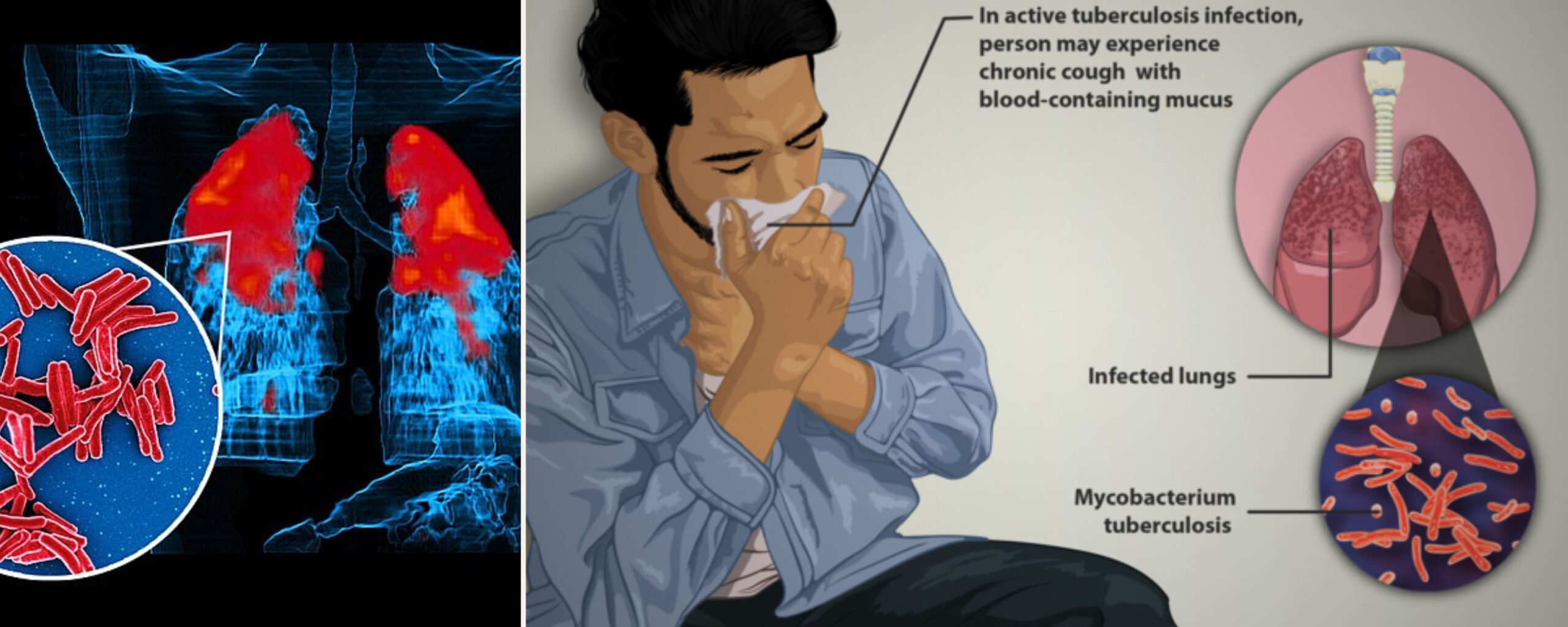 tuberculosis--the-aaartery-chronicles-tac