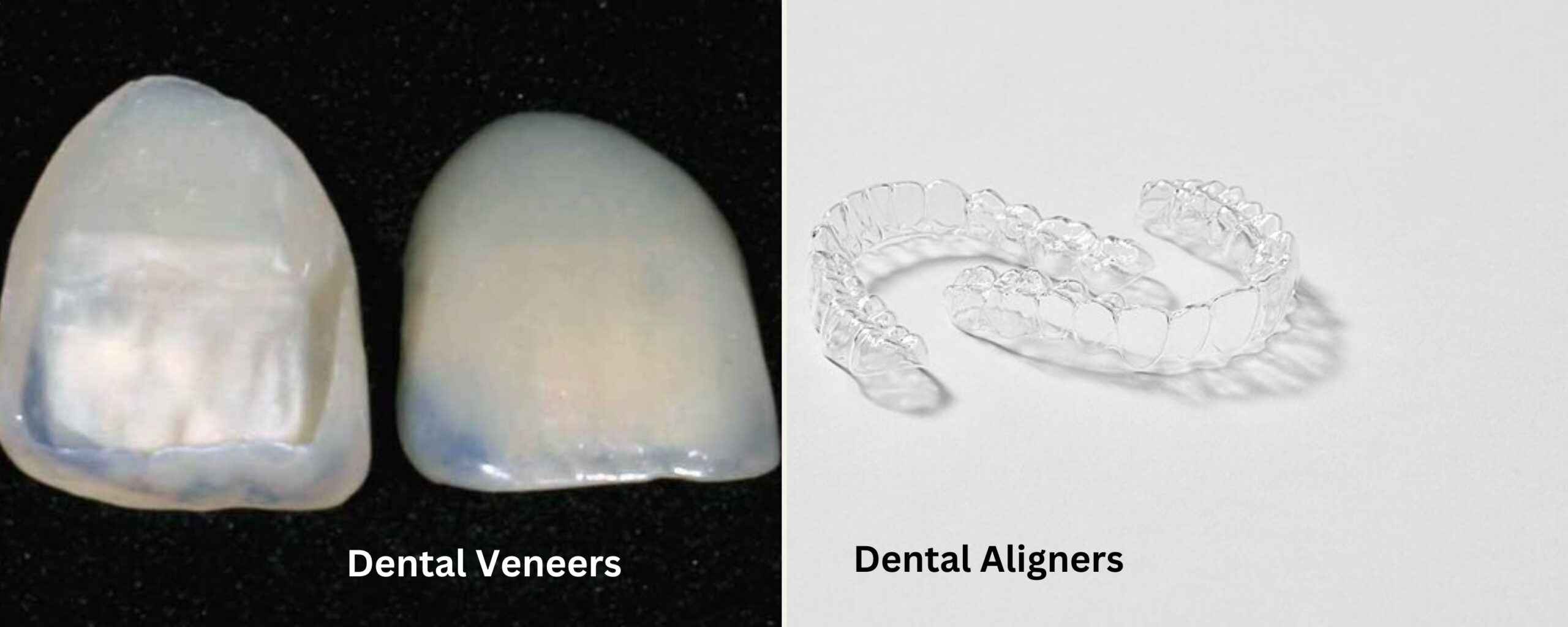 Dental-veneers-aligners-the-aartery-chronicles-tac