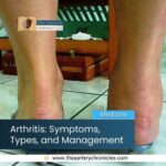 Arthritis-Symptoms-Types-and-management-the-aartery-chronicles-tac
