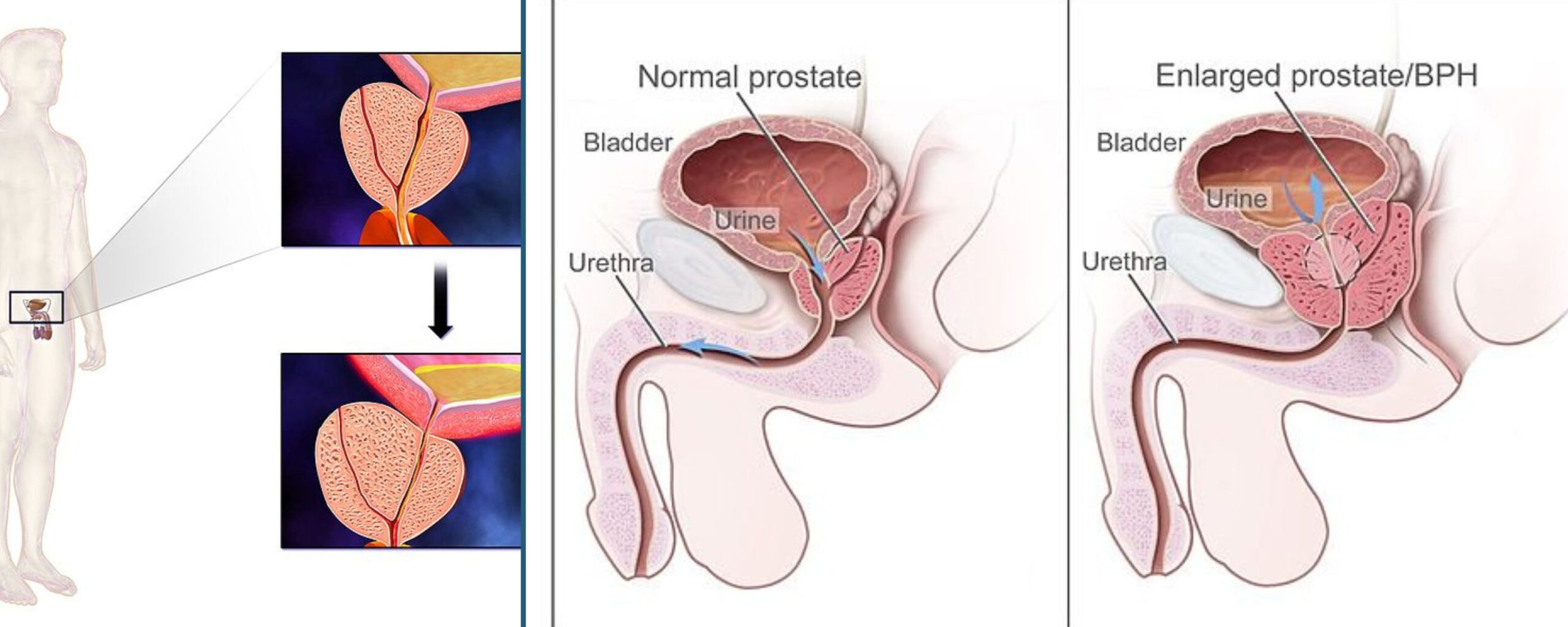 Understanding-Benign-Prostatic-Hyperplasia-(BPH)-The-Aartery-Chronicles-TAC