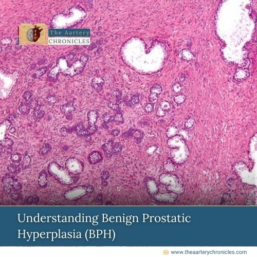 Benign-Prostatic-Hyperplasia-(BPH)-The-Aartery-Chronicles-TAC