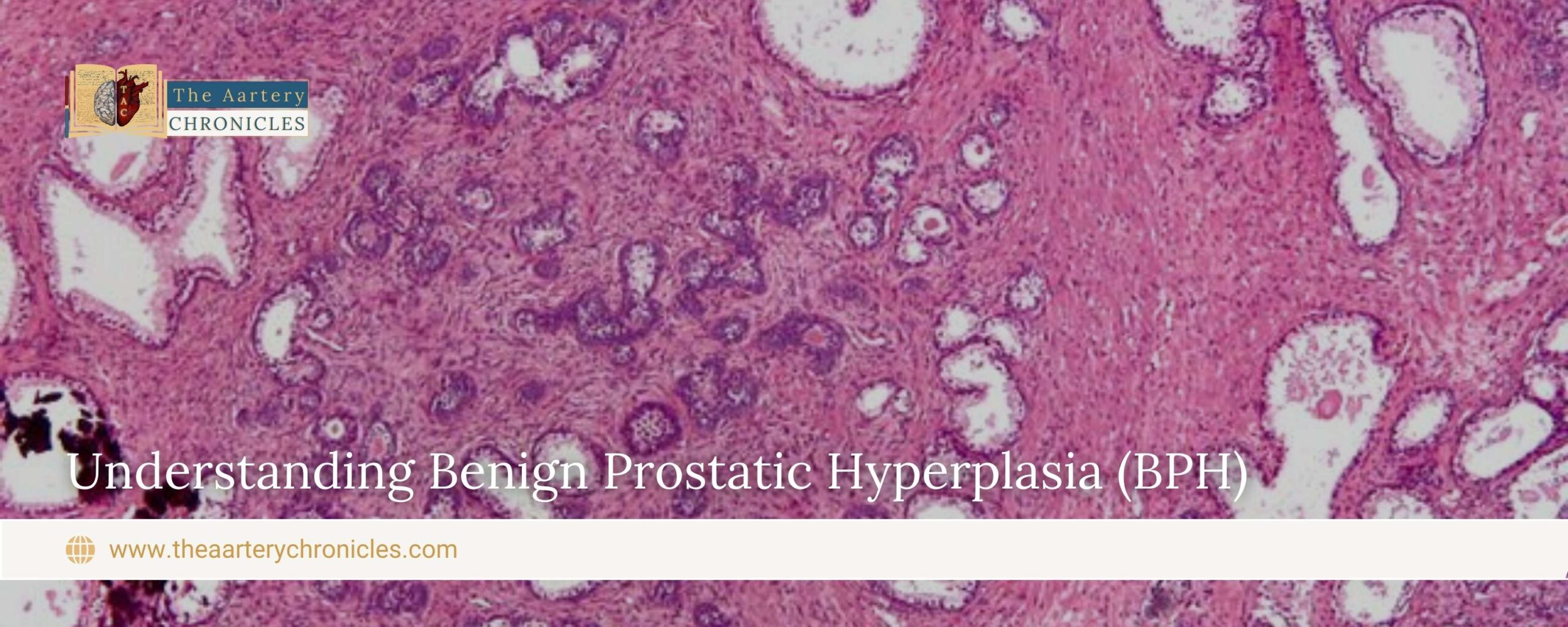 Understanding-Benign-Prostatic-Hyperplasia-(BPH)-The-Aartery-Chronicles-TAC