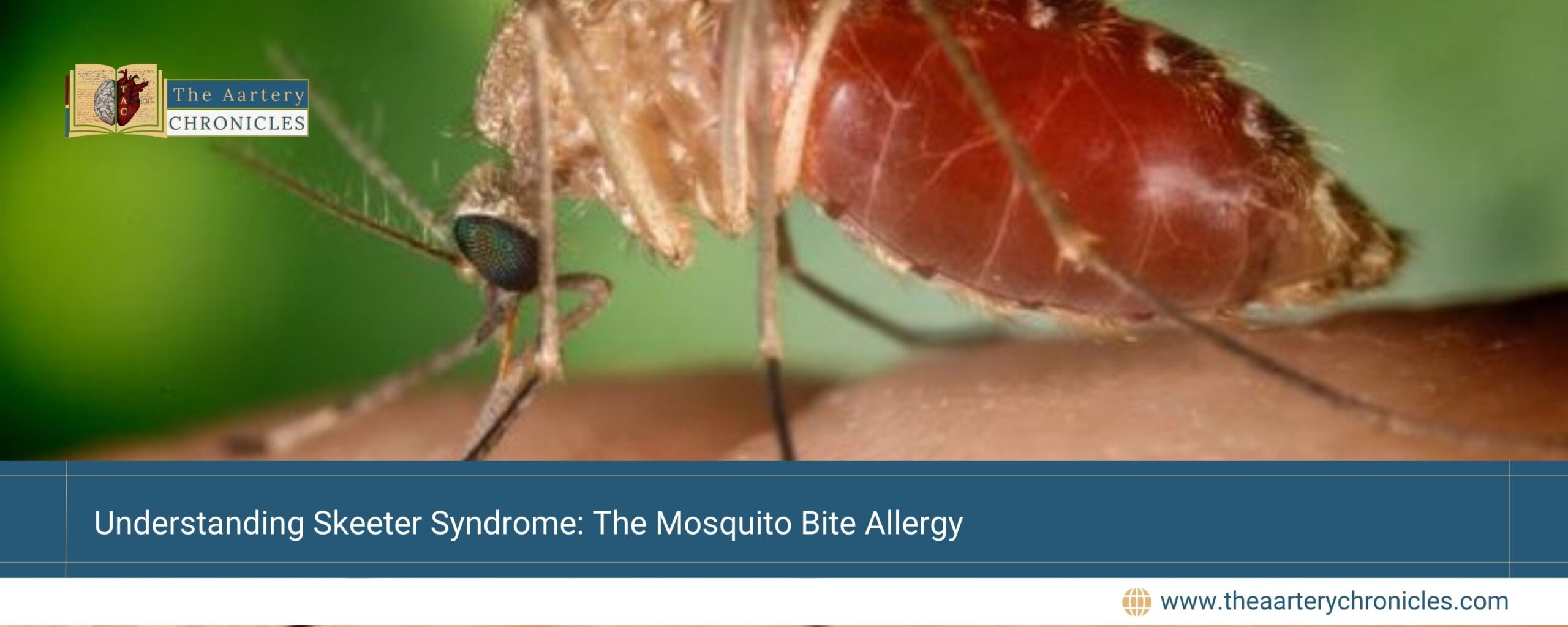 Understanding-Skeeter-Syndrome:-The-Mosquito-Bite-Allergy-The-Aartery-Chronicls-TAC