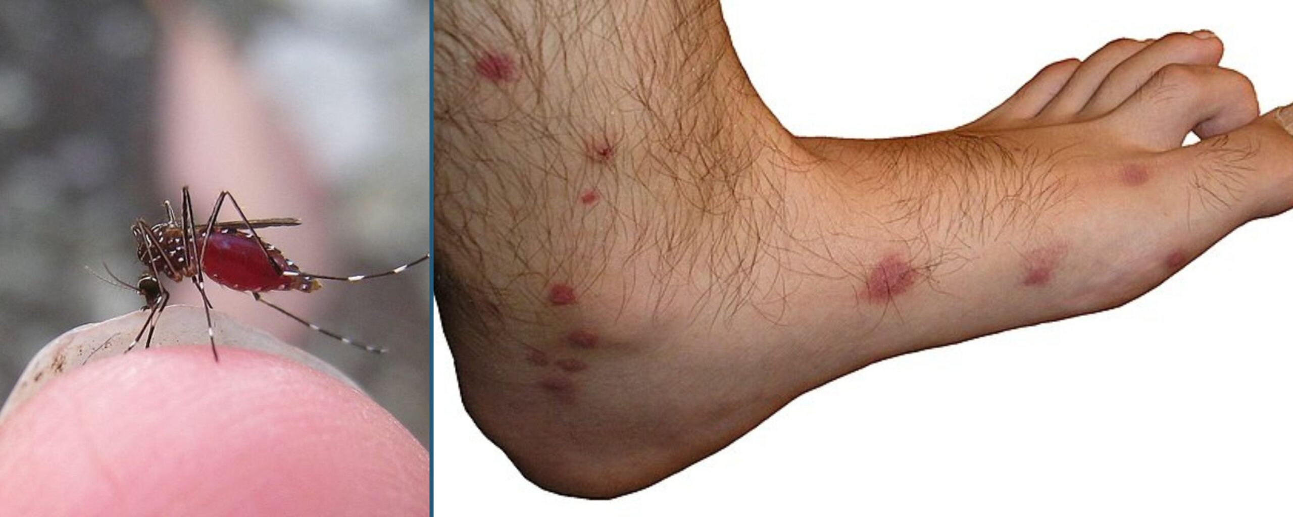 Understanding Skeeter Syndrome The Mosquito Bite Allergy Understanding Skeeter Syndrome The Mosquito Bite Allergy