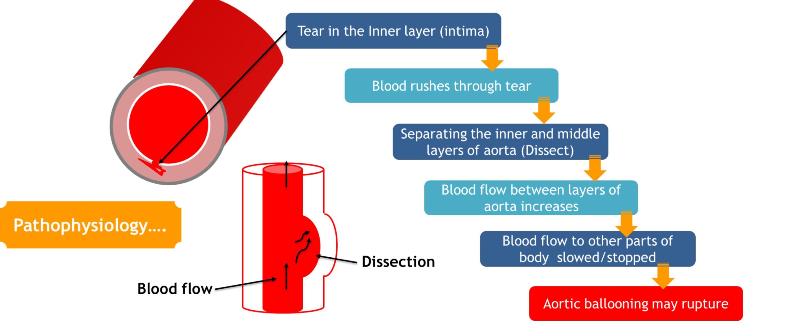 pathophysiology-of-aortic-dissection-the-aartery-chronicles-tac