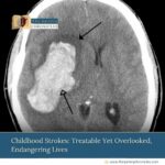 Childhood-Strokes:-Treatable-Yet-Overlooked,-Endangering-Lives-The-Aartery-Chronicles-TAC