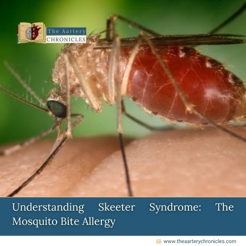 Understanding-Skeeter-Syndrome:-The-Mosquito-Bite-Allergy-The-Aartery-Chronicls-TAC