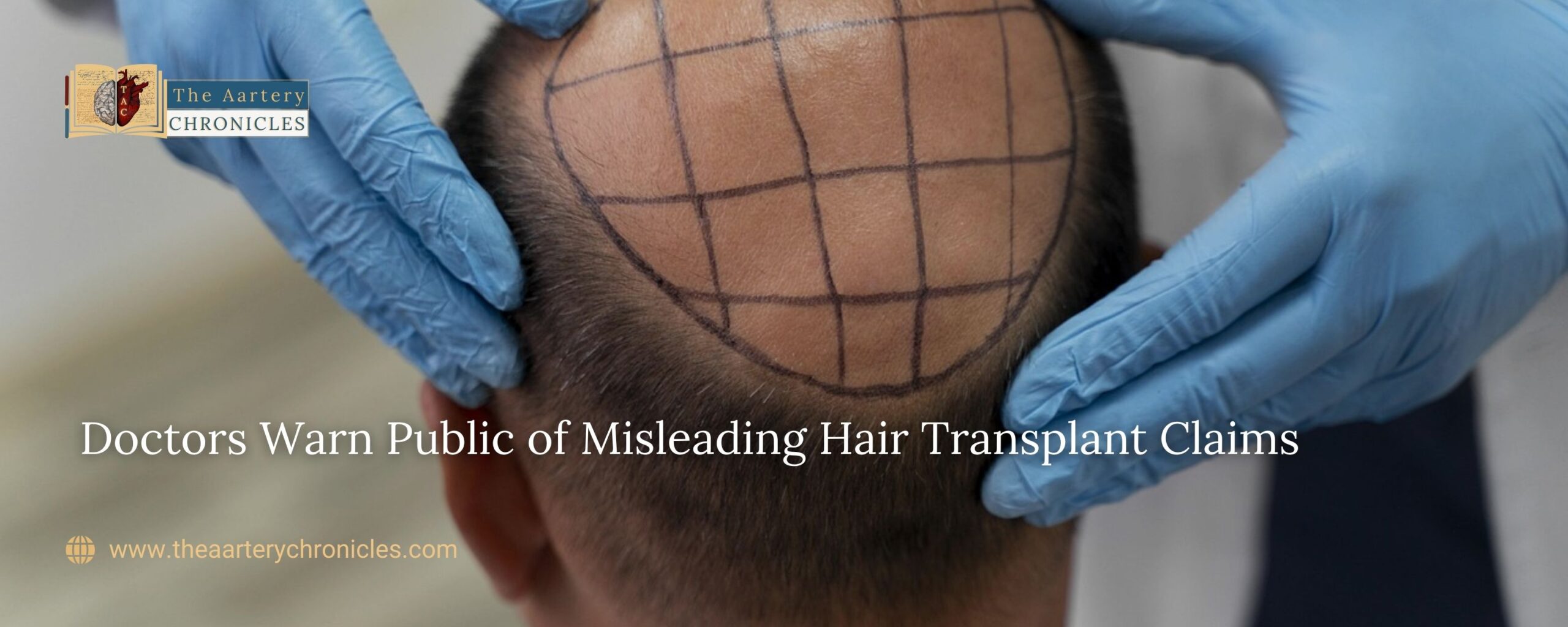 Doctors-Warn-Public-of-Misleading-Hair-transplant-Claims-the-aartery-chronicles-tac