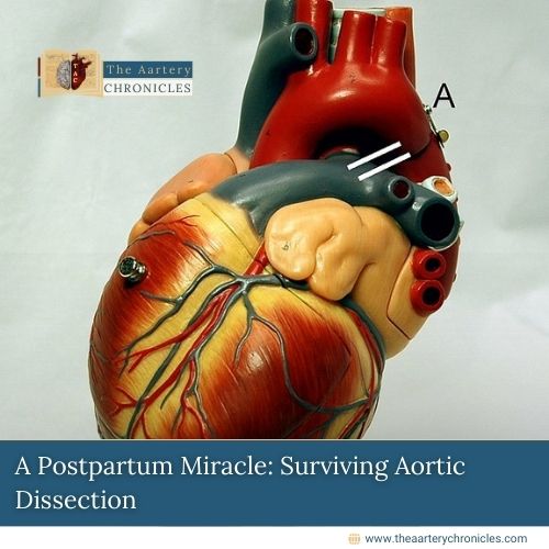 A Postpartum Miracle: Surviving Aortic Dissection