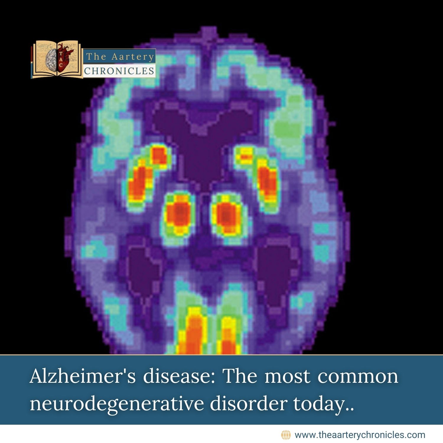 Alzheimer’s Disease: The Most Common Neurodegenerative Disorder Today