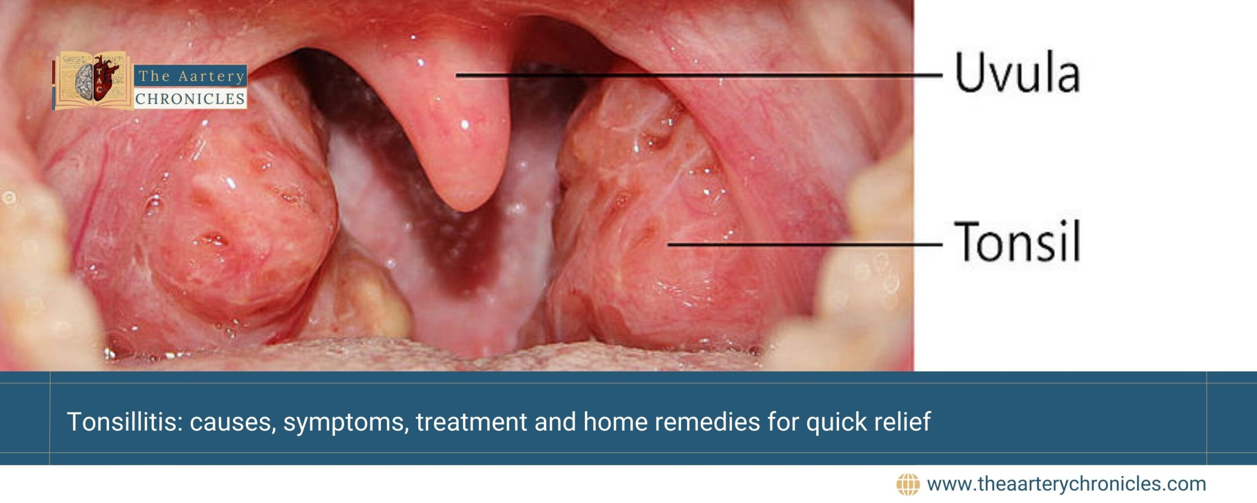 Tonsillitis:-causes,-symptoms,-treatment-and-home-remedies-for-quick-relief-The-Aartery-Chronicles-TAC