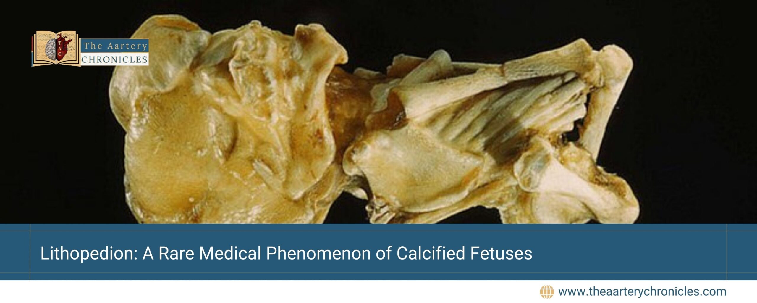 Lithopedion-Understanding-the-Rare-Condition-of-Stone-Babies-the-aartery-chronicles-tac