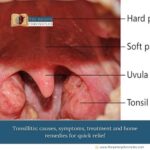 Tonsillitis:-causes,-symptoms,-treatment-and-home-remedies-for-quick-relief-The-Aartery-Chronicles-TAC