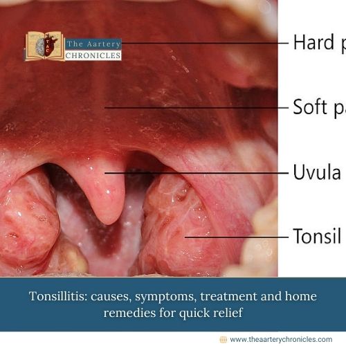 Tonsillitis: Causes, Symptoms, Treatment, and Home Remedies for Quick Relief