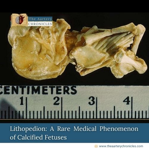 Lithopedion-Understanding-the-Rare-Condition-of-Stone-Babies-the-aartery-chronicles-tac