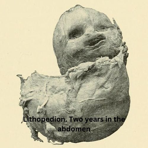 Lithopedion-Understanding-the-Rare-Condition-of-Stone-Babies-the-aartery-chronicles-tac