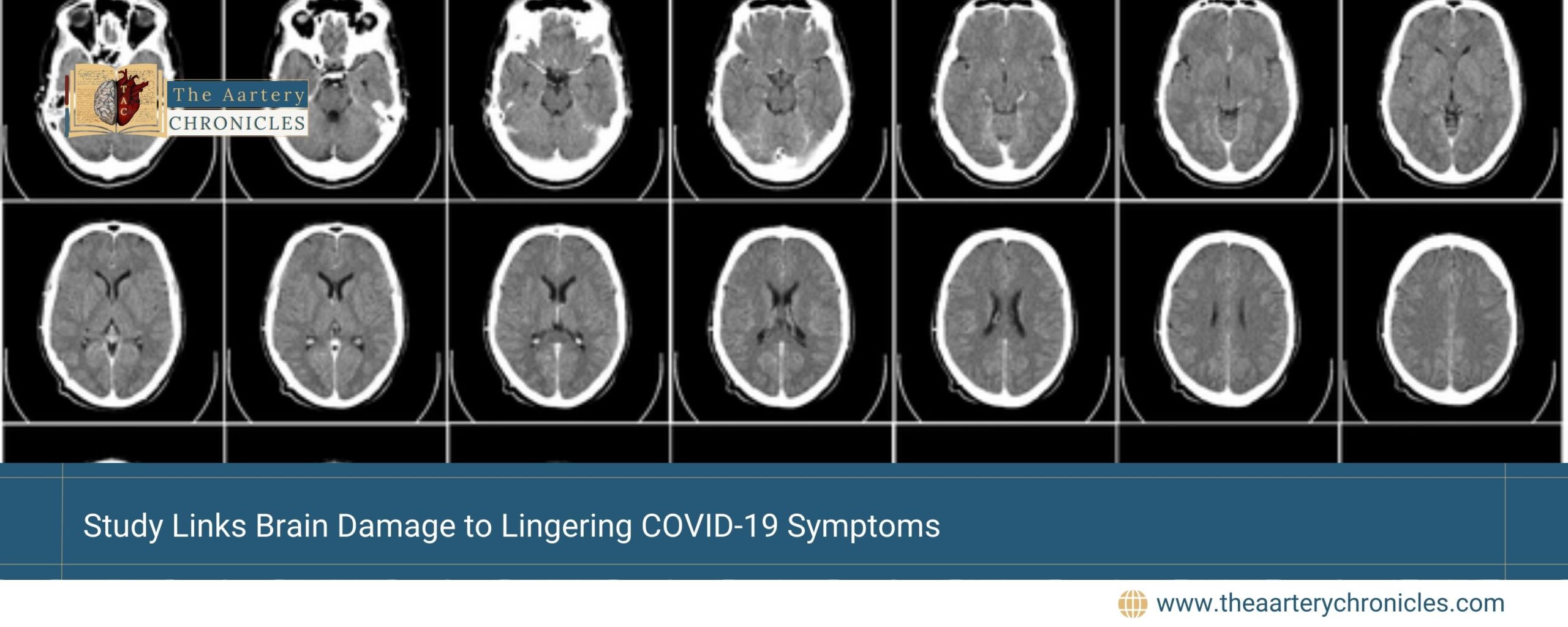 Study-Links-Brain-Damage-to-Lingering-COVID-19-Symptoms-The-Aartery-Chronicles-TAC