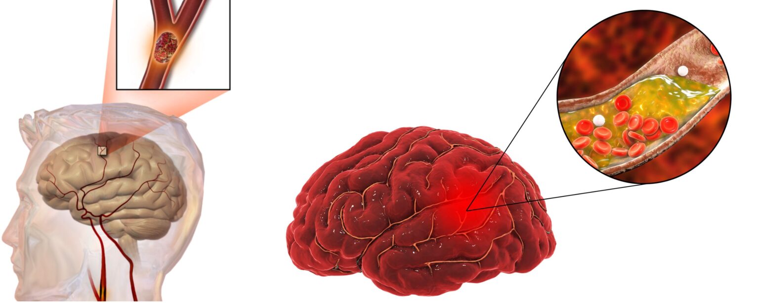 World-Stroke-Day:-Understanding-Types,-Symptoms,-Causes-&-Prevention-Tips-the-aartery-chronicles-tac