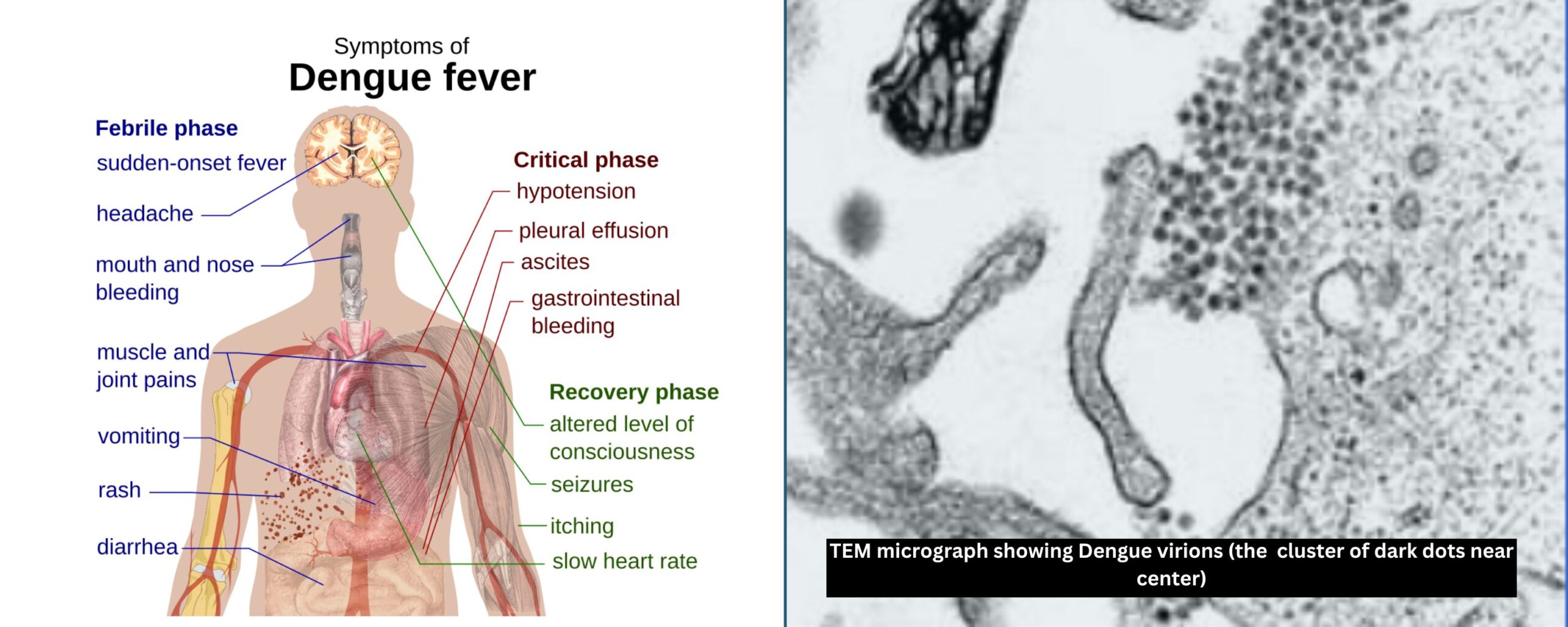 Understanding-Dengue:-Virus,-Immune-Response,-and-Control-The-Aartery-Chronicles-TAC