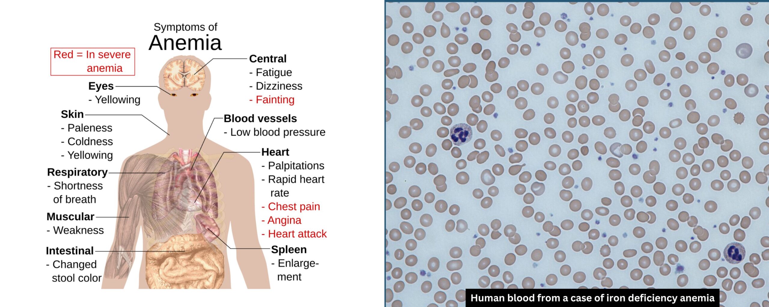 Anaemia-in-Pregnancy:-Causes,-Symptoms,-and-Management-The-Aartery-Chronicles-TAC