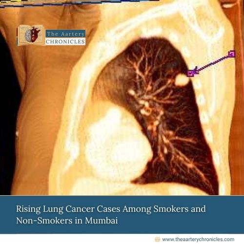 Rising Lung Cancer Cases Among Smokers & Non-Smokers in Mumbai