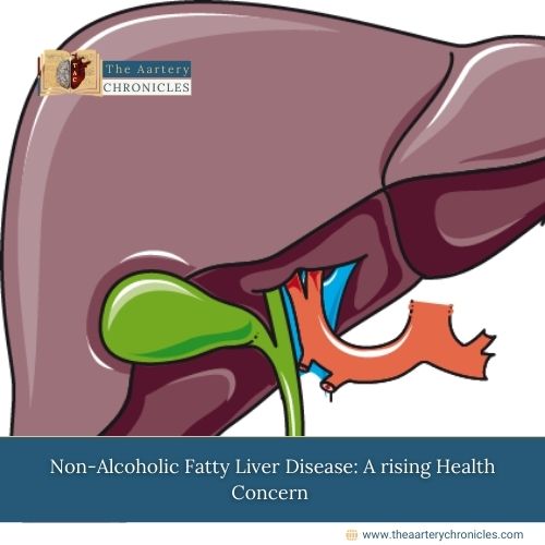 Non-Alcoholic-Fatty-Liver-Disease:-A-rising-Health-Concern-The-Aartery-Chronicles-TAC