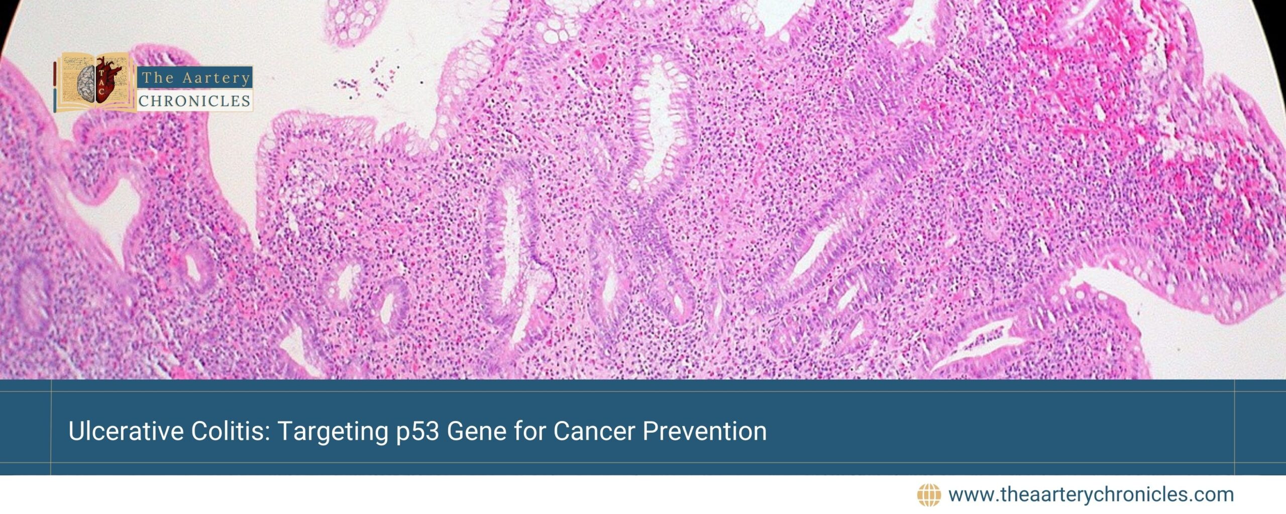 Ulcerative-Colitis:-Targeting-p53-Gene-for-Cancer-Prevention-The-Aartery-Chronicles-TAC