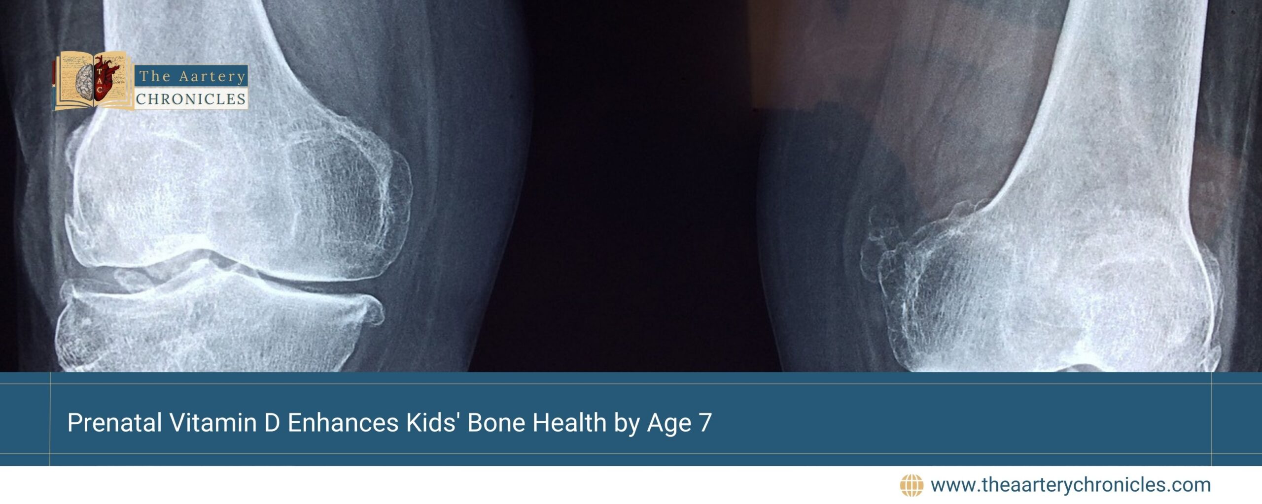 Prenatal-Vitamin-D-Enhances-Kids'-Bone-Health-by-Age-7-The-Aartery-Chronicles-TAC