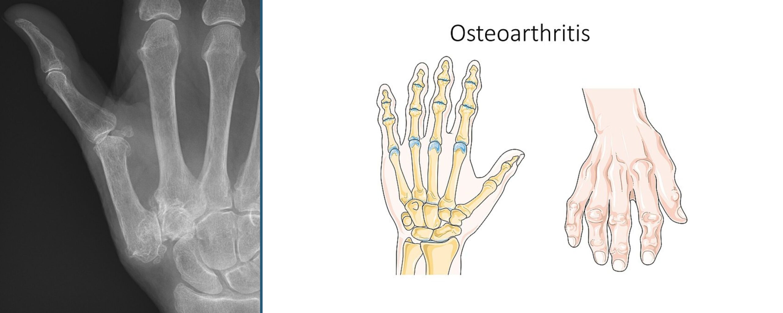 Understanding-Osteoarthritis:-Causes,-Symptoms,-&-Management-The-Aartery-Chronicles-TAC