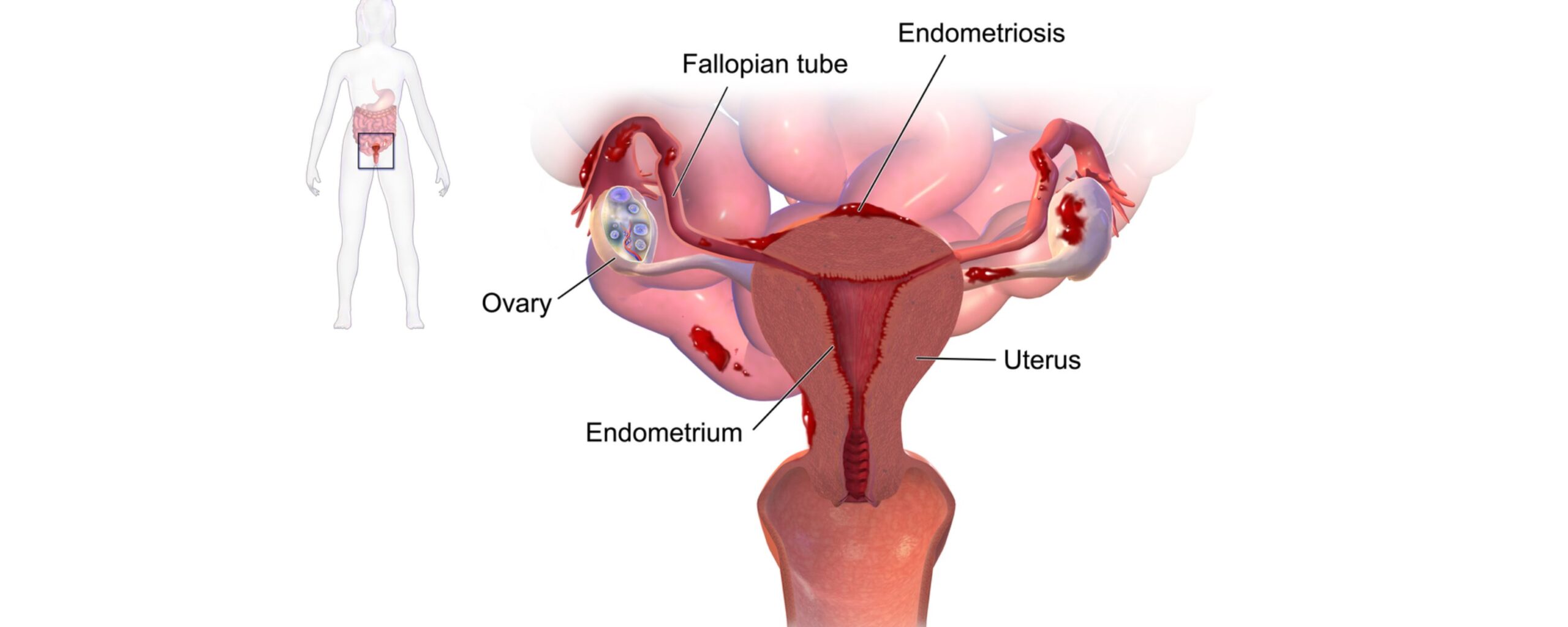 Endometriosis-Insights:-Everything-you-need-to-know-The-Aartery-Chronicles-TAC