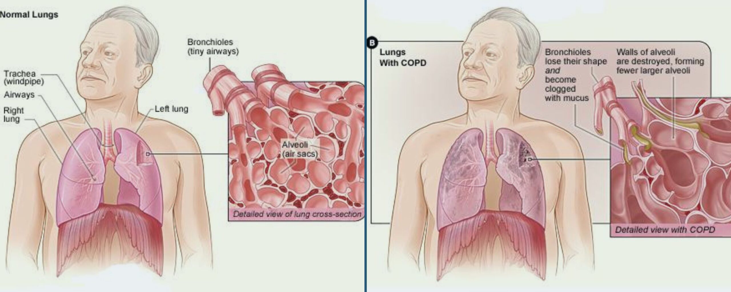 Breathing-Easy:-Celebrating-Resilience-on-World-COPD-Day-The-Aartery-Chronicles-TAC