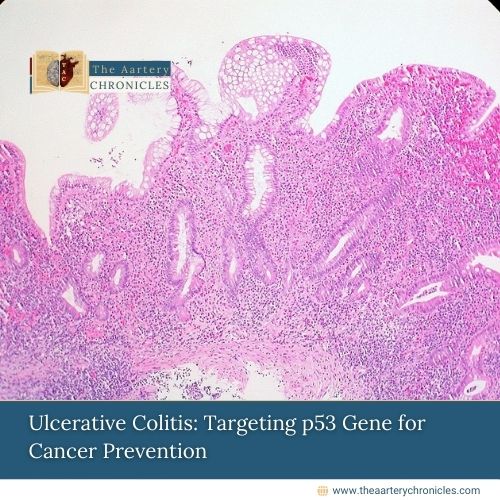 Ulcerative Colitis: Targeting p53 Gene for Cancer Prevention