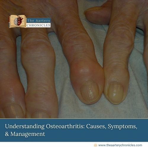 Understanding-Osteoarthritis:-Causes,-Symptoms,-&-Management-The-Aartery-Chronicles-TAC