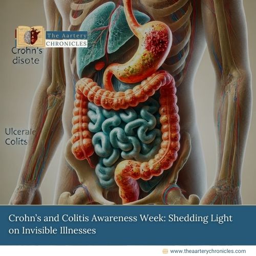 Crohn’s-and-Colitis-Awareness-Week:-Shedding-Light-on-Invisible-Illnesses-The-Aartery-Chronicles-TAC