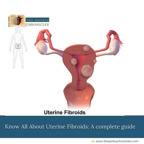 Know All About Uterine Fibroids: A complete guide