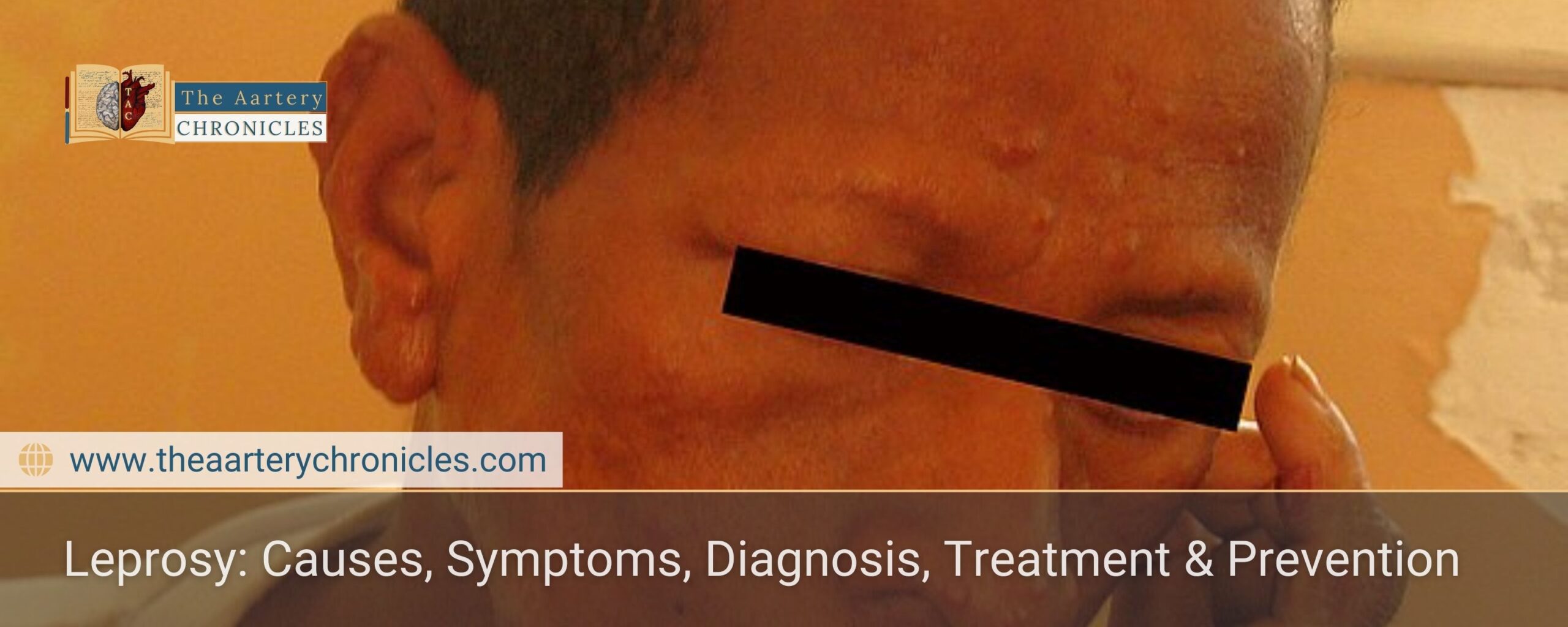 leprosy-causes-symptoms-treatment-prevention-that-you-need-to-know-the-aartery-chronicles-tac