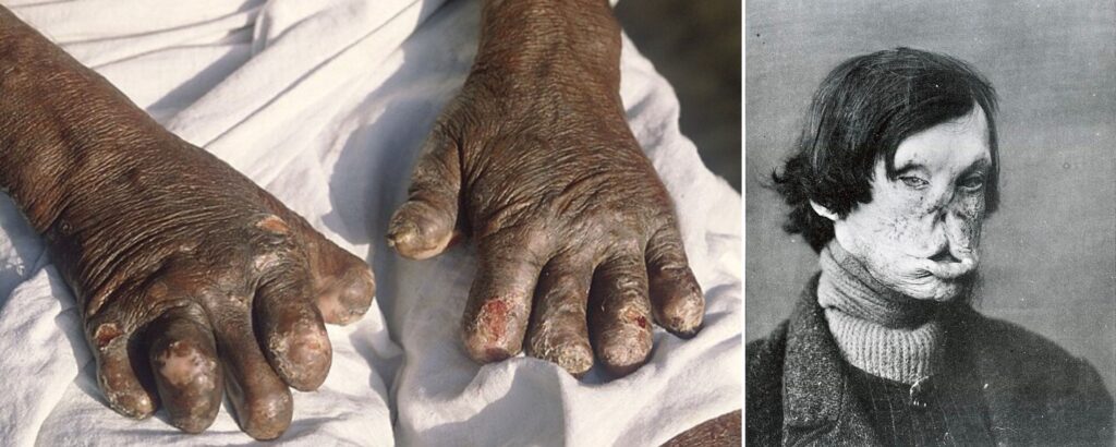 leprosy-causes-symptoms-treatment-prevention-that-you-need-to-know-the-aartery-chronicles-tac