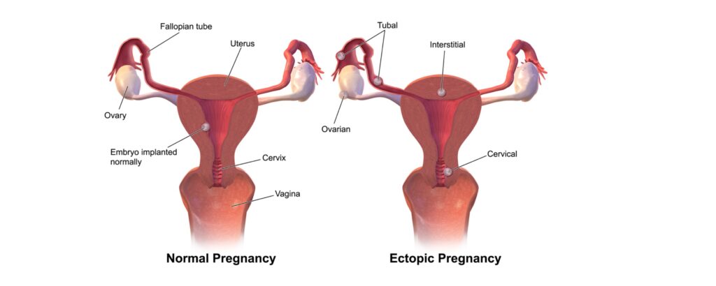 What-Is-an-Ectopic-Pregnancy?-Key-Facts-You-Need-to-Know-The-Aartery-Chronicles-TAC