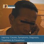 leprosy-causes-symptoms-treatment-prevention-that-you-need-to-know-the-aartery-chronicles-tac