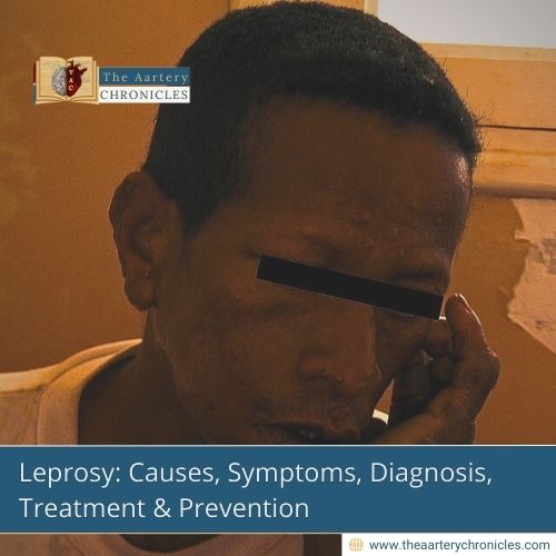 Leprosy: Causes, Symptoms, Treatment & Prevention that you need to know